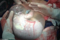 Khoảnh khắc cực hiếm: Em bé chào đời vẫn nằm trong túi nước ối