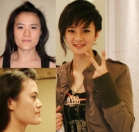 Những hình ảnh trước và sau phẫu thuật gây shock ở Hàn