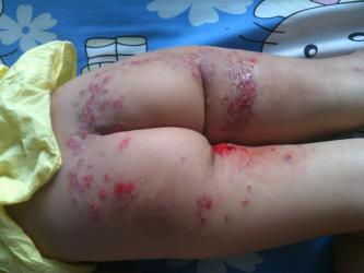 Bệnh chàm (Eczema) và Bài thuốc trị dứt điểm tận gốc