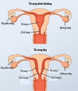 Cuộc sống tình dục bất ngờ của cô gái có 2 âm đạo - ae nào thắc mắc ko ;))